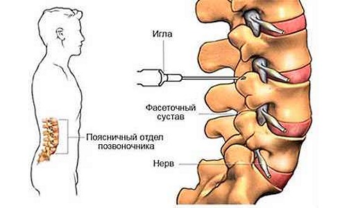 При необходимости быстрого реагирования и устранения острой боли применяют блокады