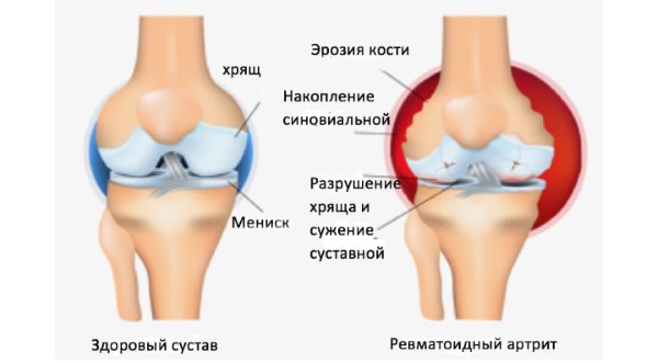 Седал М справляется с умеренными болями в суставах
