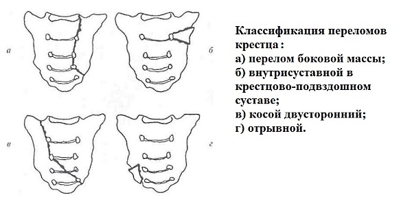 Перелом крестца может классифицироваться по расположению перелома