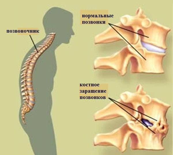 Болезнь Бехтерева является одним из основных показаний к приему Наклофена