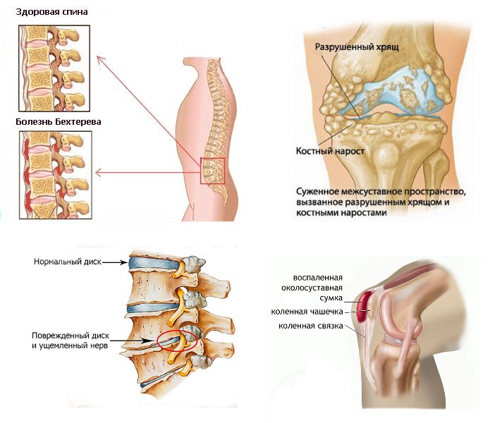 Артрокам обладает противовоспалительным дейтвием, поэтому его назначают при различных заболеваниях суставов