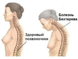 Обратите внимание на особенности протекания болезни Бехтерева у женщин