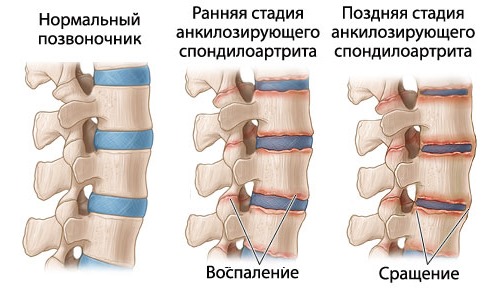 Ниже описано течение стадий болезни Бехтерева