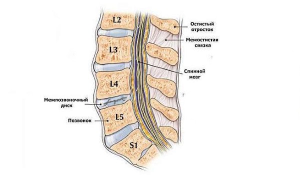 Хондроз на начальной стадии протекает без симптомов
