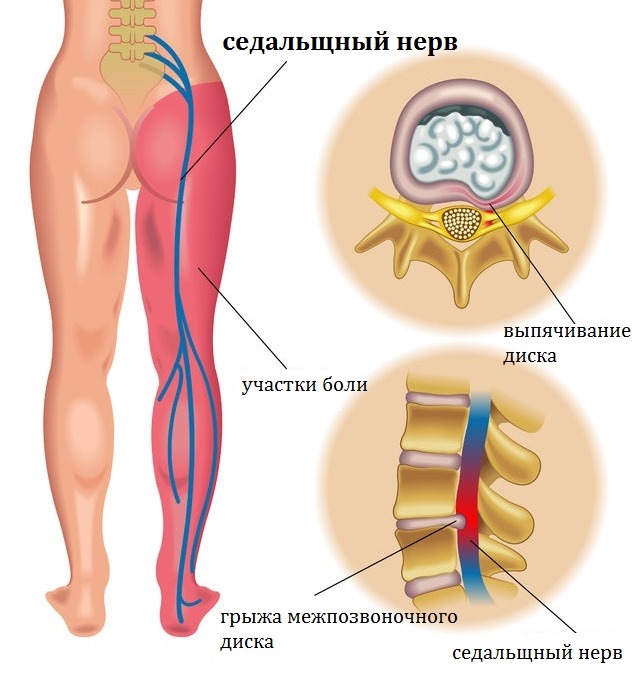 Боль в пояснице отдающая в ногу говорит о неврологических причинах