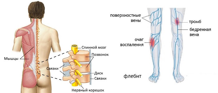 Феброфид можно использовать как при невралгических заболеваниях, так и при воспалениях вен