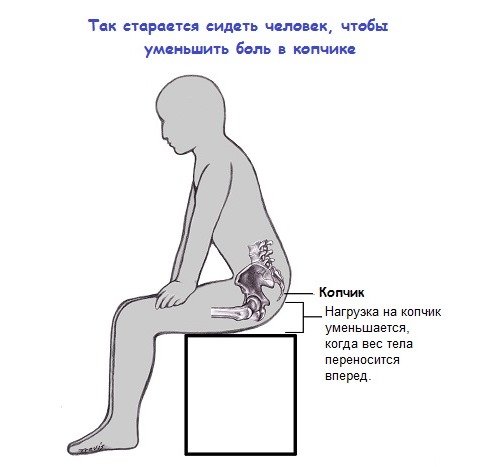 При сильных и острых болях в копчике необходимо исключить сидячую работу и физические нагрузки
