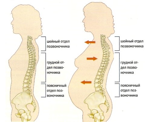 Женщины при беременности часто сталкиваются с поясничными болями