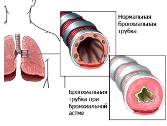 Людям страдающим от бронхиальной астмы противопоказан препарат