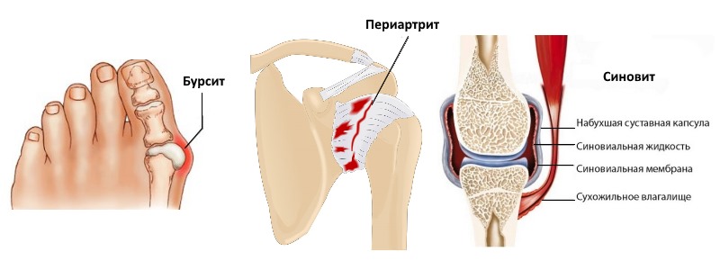 Противовоспалительный препарат Быструмкапс назначают для лечения воспалительных процессов в суставах