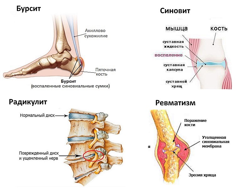 Обратите внимание при каких заболеваниях применяют Кеторол в виде геля