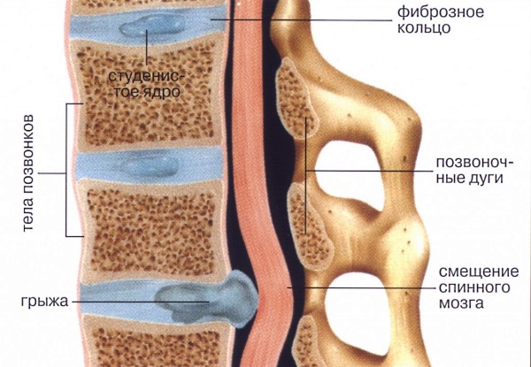 Прострелы появляются при прогрессировании позвоночной грыжи
