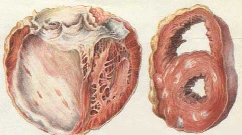 кардиосклероз