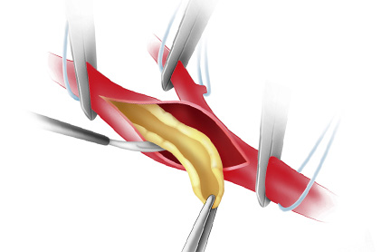 Каротидная эндартерэктомия