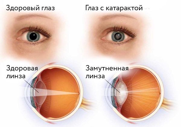 Ортофен для местного применения может использоваться после удаления катаракты на глазу