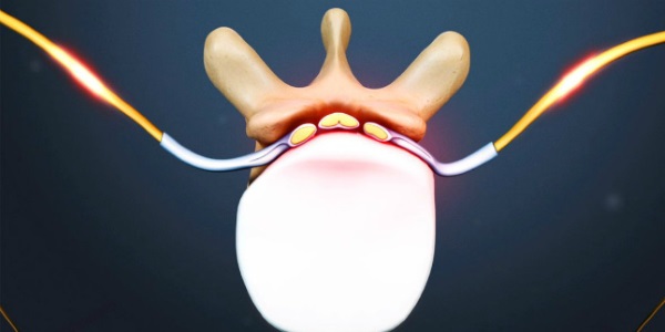 Характер боли при цервикалгии зависит от причин ее возникновения