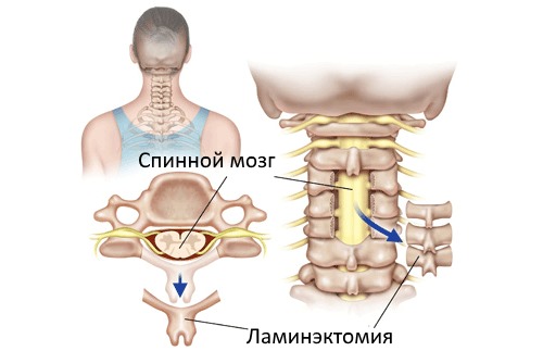 Ламинэктомию производят с целью уменьшения компрессии спинного мозга
