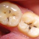 черные полоски на зубах, кариес