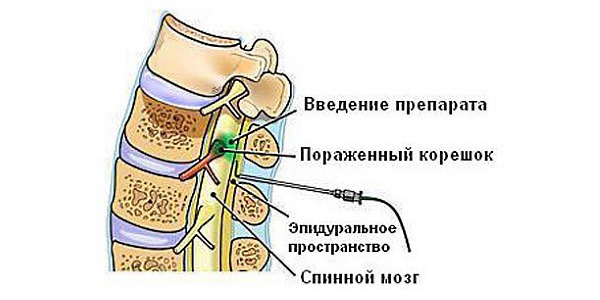 Эпидуральную блокаду применяют при сильной боли в спине, которую не останавливает ни одно средство