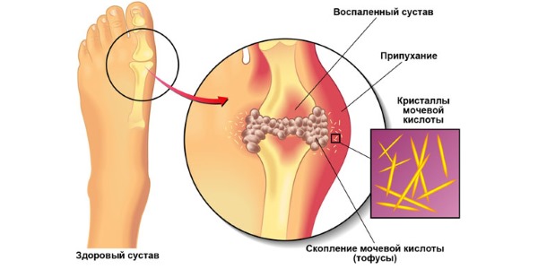 Аденурик используют только для лечения подагры