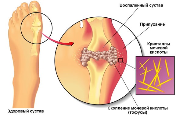 Подагра развивается из-за нарушения в организме баланса мочевой кислоты