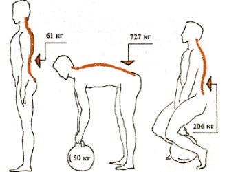 Повышенные нагрузки - основная причина развития межпозвоночной грыжи