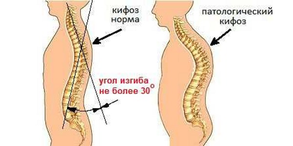 Степень кифоза определяется на основании измерений угла искривлений