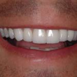 Чувствительность зубов после установки виниров