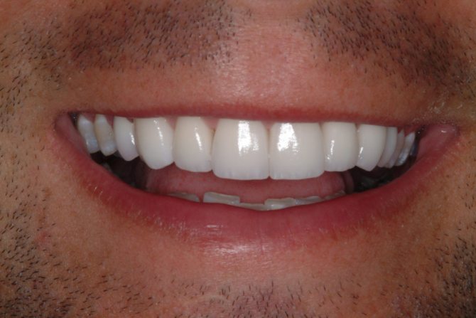 Чувствительность зубов после установки виниров