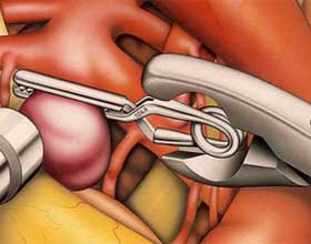 клипирование аневризмы