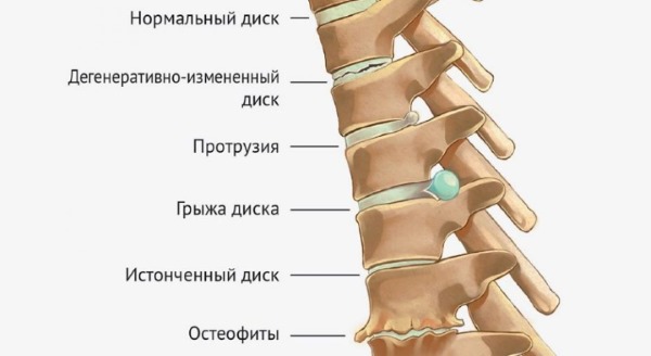 ЛФК от шейного остеохондроза показана на всех стадиях развития заболевания