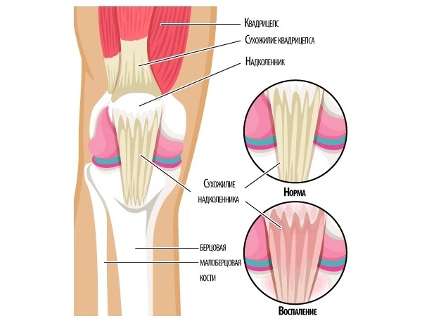 Долобене можно использовать при воспалениях в опорно-двигательной системе