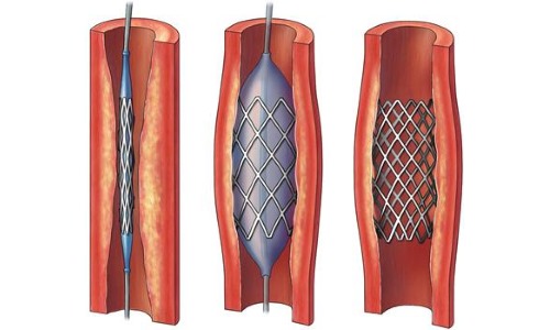 Хирургическое лечение плохого тока крови в сосудах головы заключается в стентировании