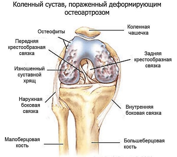 Остеоартроз и артроз являются показаниями к применению Артрадола