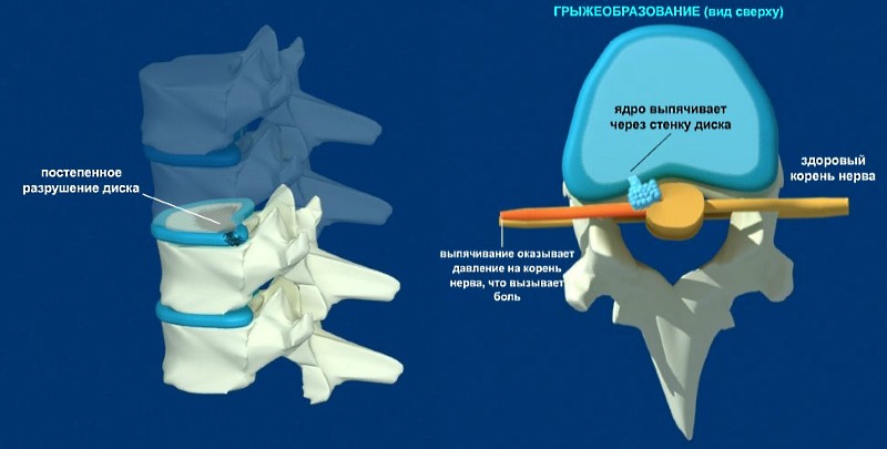Грыжа межпозвонкового диска может возникать во всех отделах позвоночника