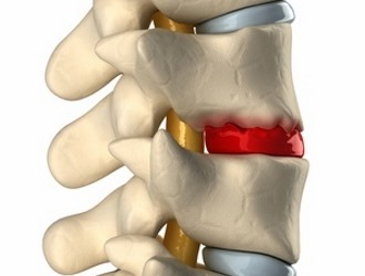 При нестабильности позвонков возможно разрастание остеофитов