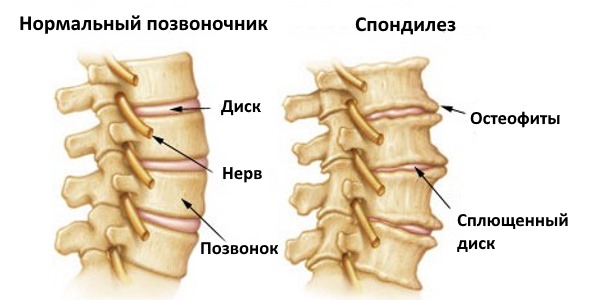 Спондилез возникает из-за дегенеративных изменений в позвонках