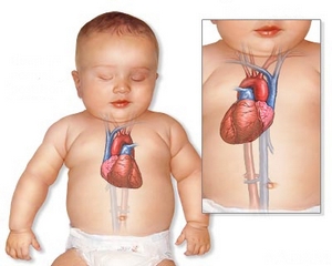 декстрокардия у ребенка
