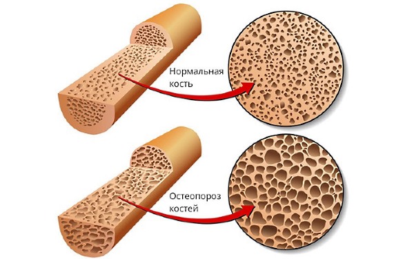 Осталон используют для профилактики и лечения остеопороза