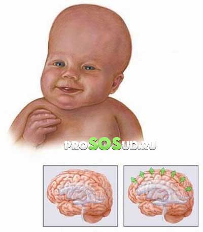 детская форма болезни