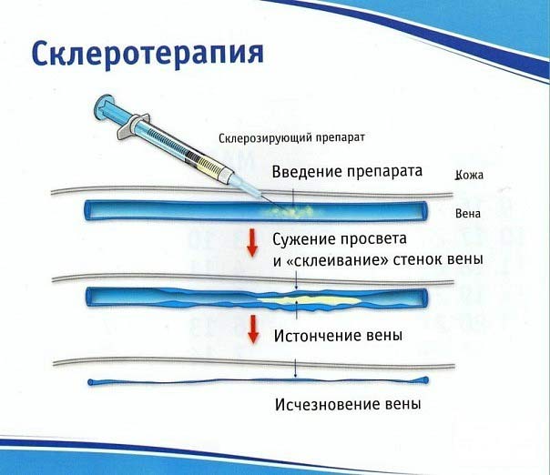 эфект от скреротеропии