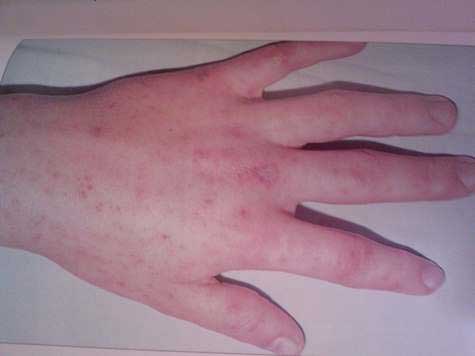 диатез на руке