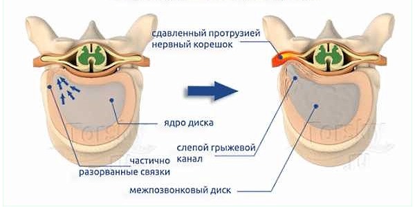 Схема формирования протрузии диска