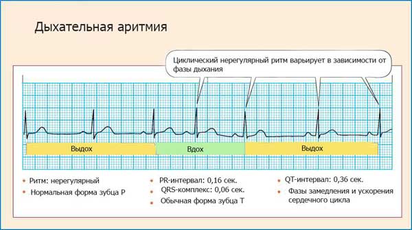проявление дыхательной аритмии на ЭКГ