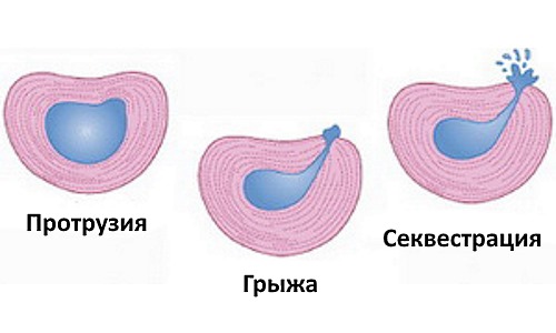 Если лечение выпячивание позвоночного диска вовремя не начать, то оно в дальнейшем перерастает в грыжу позвоночника