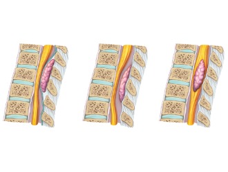 Невриномы позвоночника бывают доброкачественными и злокачественными