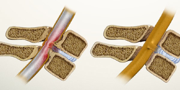 При обострении заболевания необходимо выполнять упражнения на растяжку позвоночника, которые снимут болевой синдром