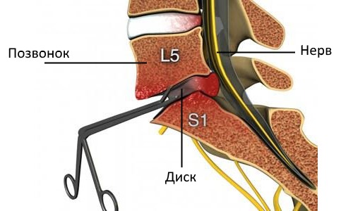 При слишком больших протрузиях возможно проведение оперативного вмешательства - дискэктомии