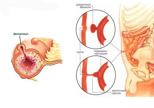 Дивертикул Меккеля