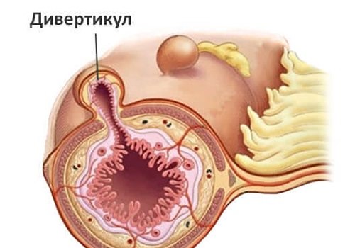 Дивертикулез кишечника